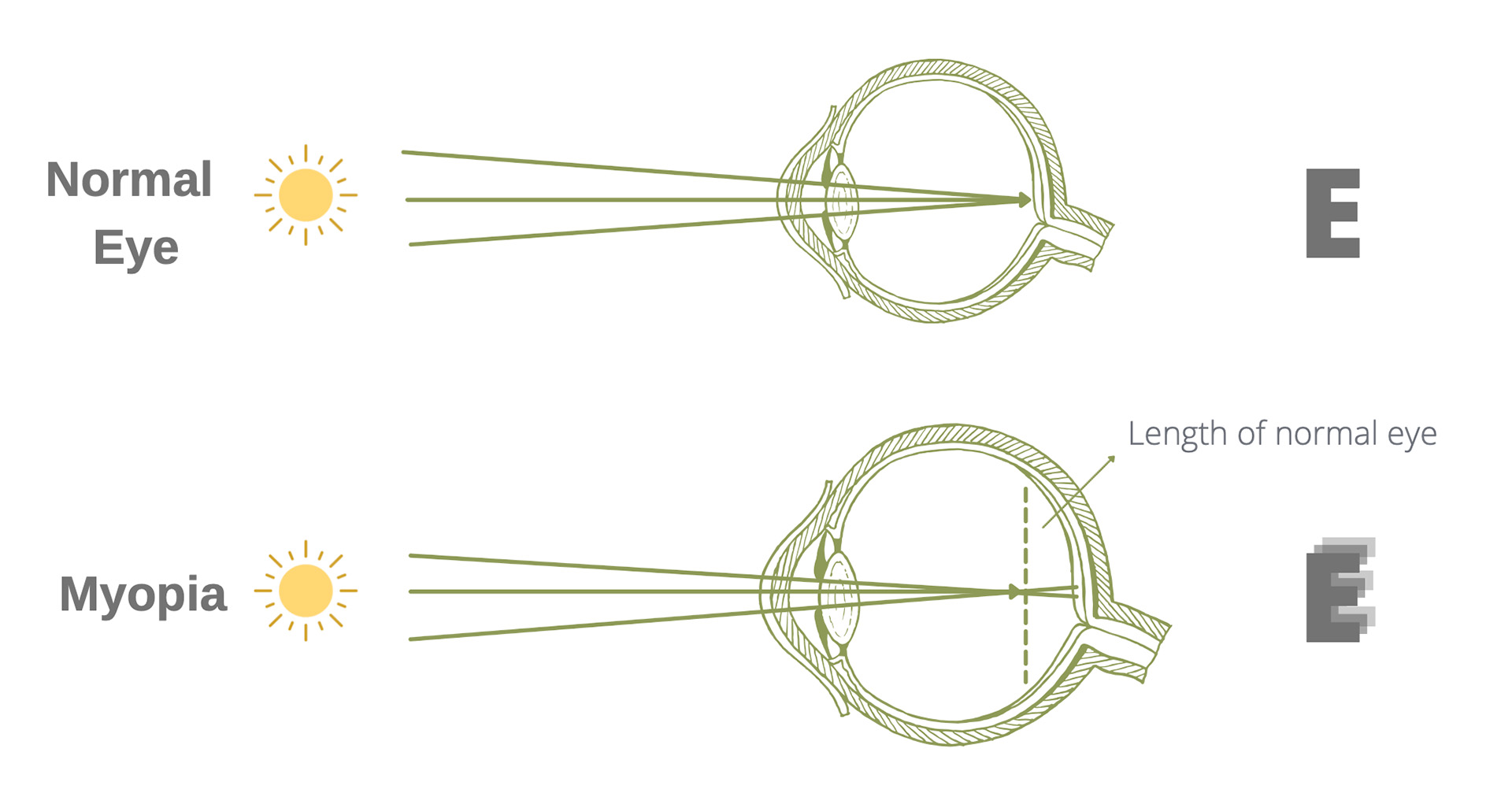 Diagram of a normal eye compared to a myopic eye.